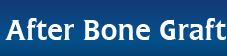 After Bone Graft After Bone Graft