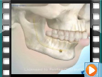 Orthognathic Surgery Orthognathic Surgery