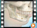 Orthognathic Surgery