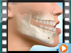 Orthognathic Surgery