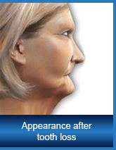 Appearance after tooth loss