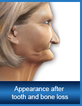 Appearance after tooth and bone loss