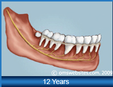 Wisdom Teeth in 12 Years