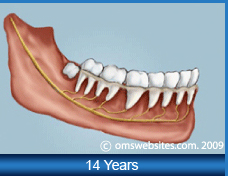 Wisdom Teeth in 14 Years