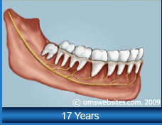 Wisdom Teeth in 17 Years