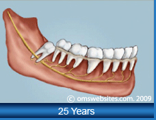 Wisdom Teeth in 25 Years