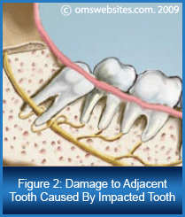 Figure 2 : Damage to Adjacent Tooth Caused By Impacted Tooth